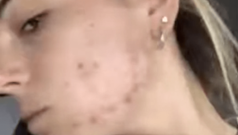 thumbnail of acne treatment video